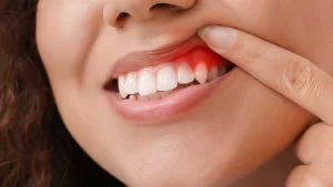 حساسیت به خمیر دندان